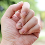 Fungus Infection On Nails Hand, Finger With Onychomycosis, A Toe