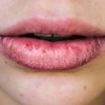 225768-674×450-dry-chapped-lips