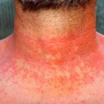 dermititis should be dermatitisRed skin rash on a man´s neck and chest due to scarlet fever, fever, dermatitis or eczema