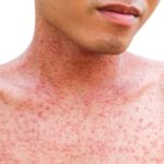 allergy-asian-background-body-care-closeup-d-20190425175036-44492400