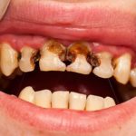 Neglected teeth – Extended cavities.