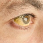 jaundice-is-a-sign-of-yellow-fever